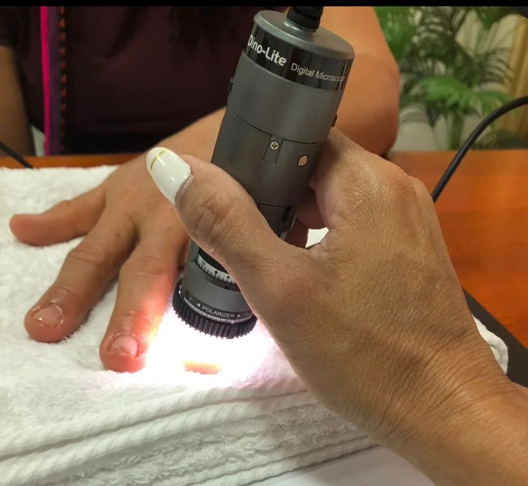 Fotografía del procedimiento: Capilaroscopía