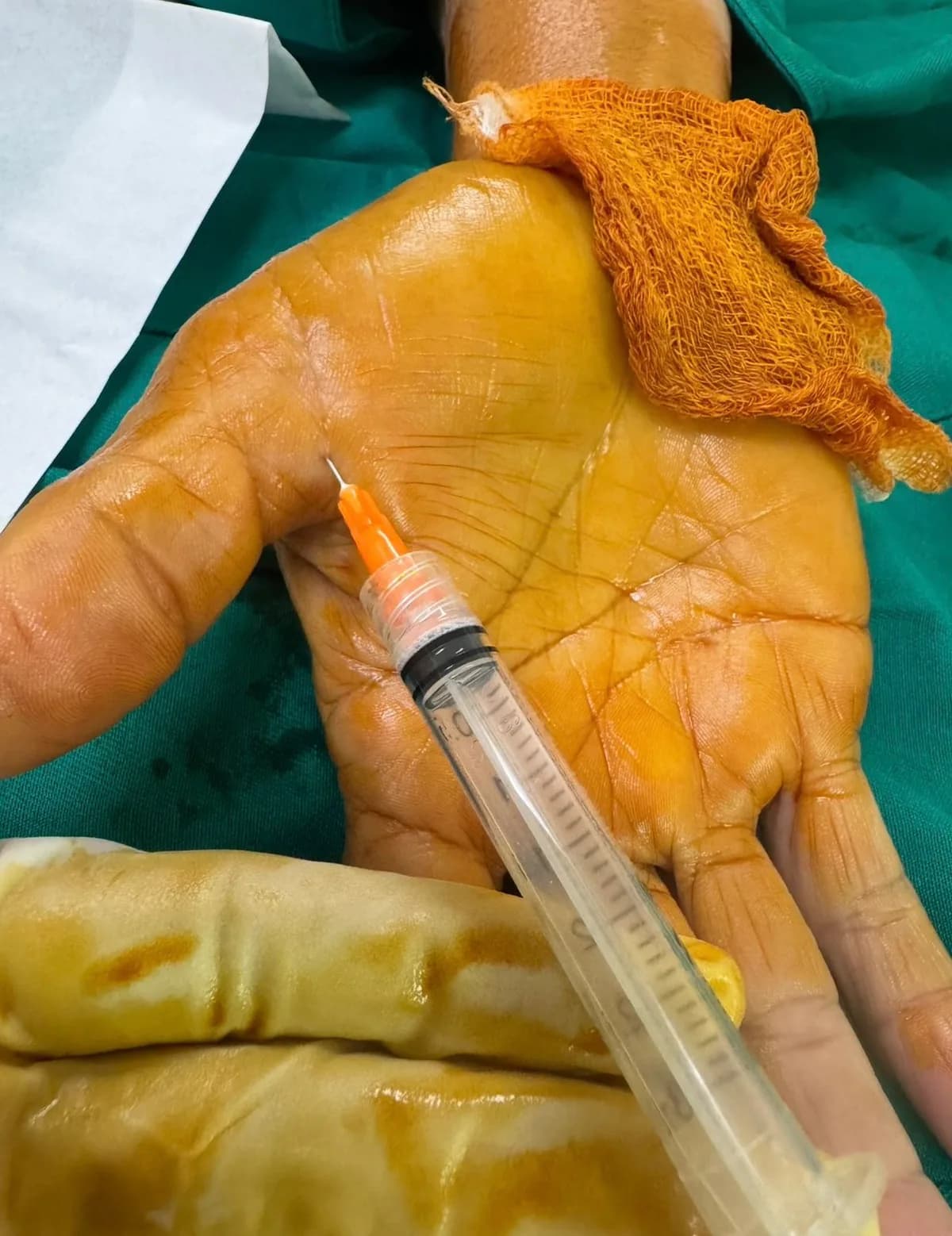 Fotografía del procedimiento: Infiltración articular