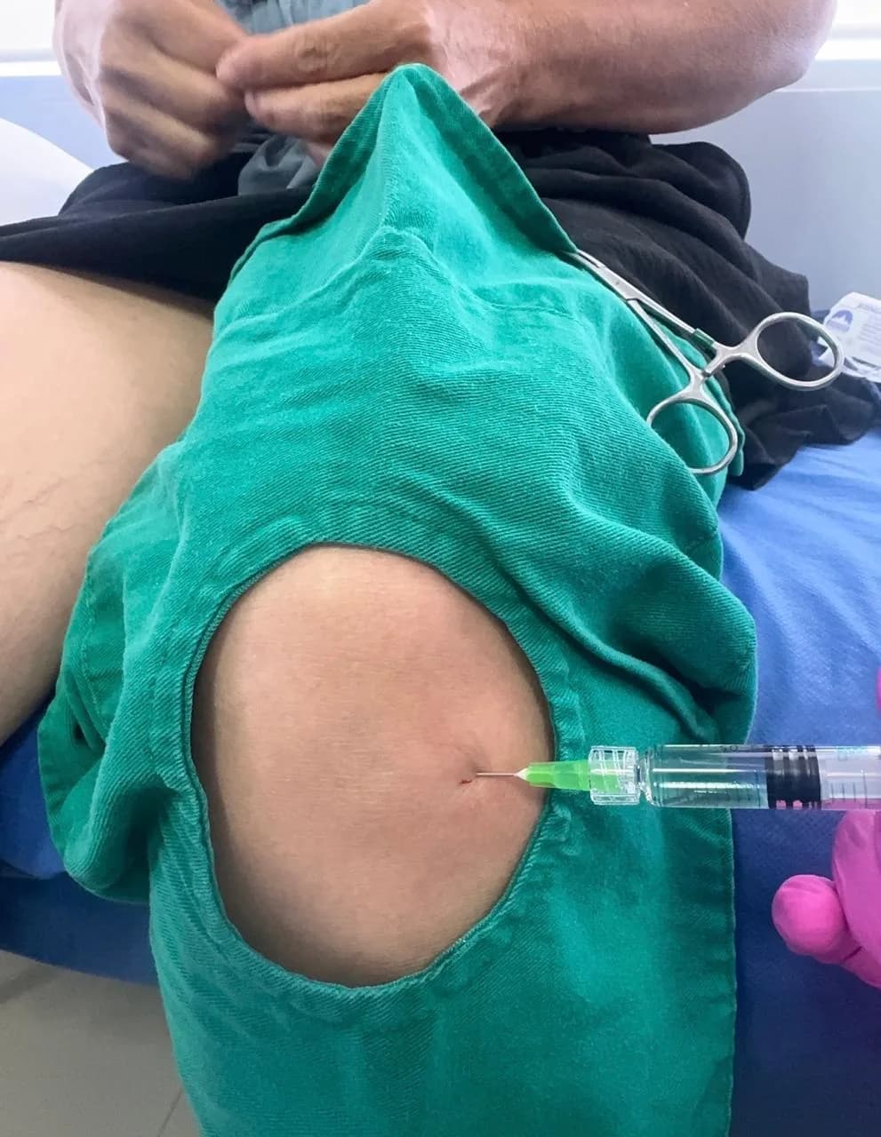 Fotografía del procedimiento: Viscosuplementación